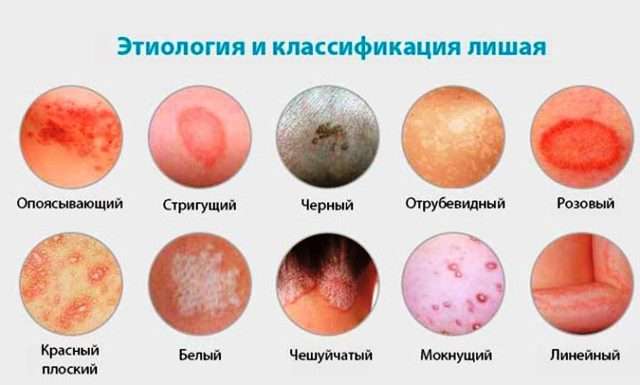 Что такое лишай и как его следует лечить, чтобы не причинить вред