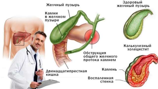 Холецистит: как распознать проблемы с желчным пузырем и что делать