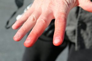Какие признаки указывают на появление ковидных пальцев