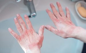 Какие признаки указывают на появление ковидных пальцев