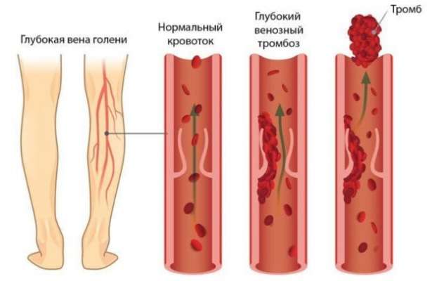 Насколько опасно образование тромбов и в каких случаях следует проверяться на склонность к тромбозу
