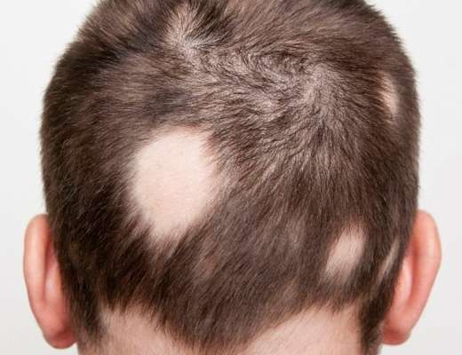Облысение у мужчин: причины, лечение и профилактика